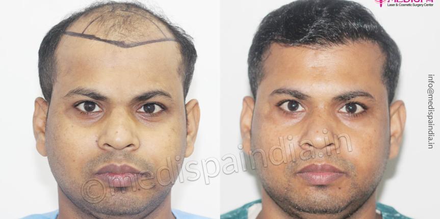 hair restoration jaipur rajasthan