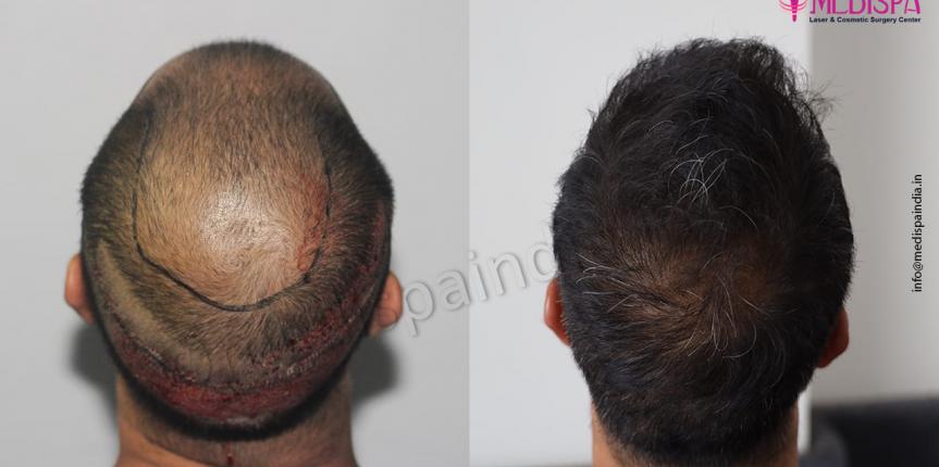 hair restoration result in india