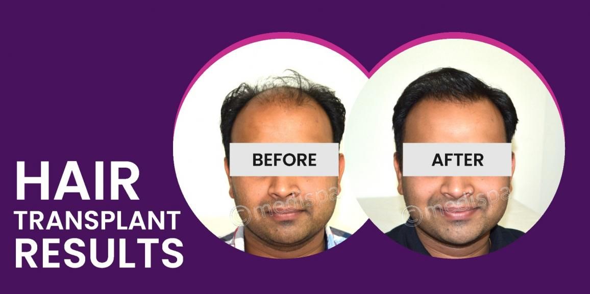 How To Achieve Successful Results With Hair Restoration?