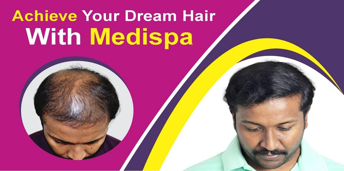 The Ultimate Solution To Baldness: Hair Transplant Surgery