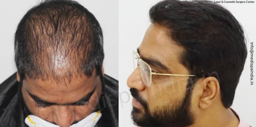 hair transplant cost in bangalore