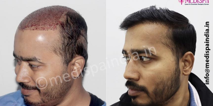 wrong hair transplant repair in delhi, india