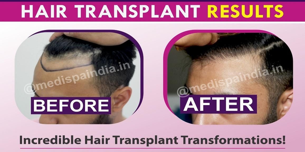 Why To Choose The Experienced Doctor For Hair Transplantation?