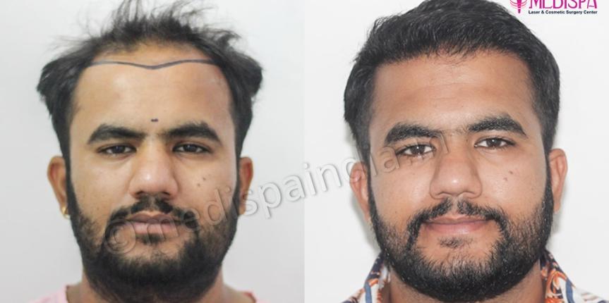 hair restoration results in rajasthan