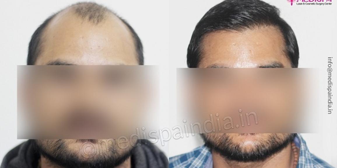 Is Choosing Hair Transplant Can Be Considered As The Right Choice?