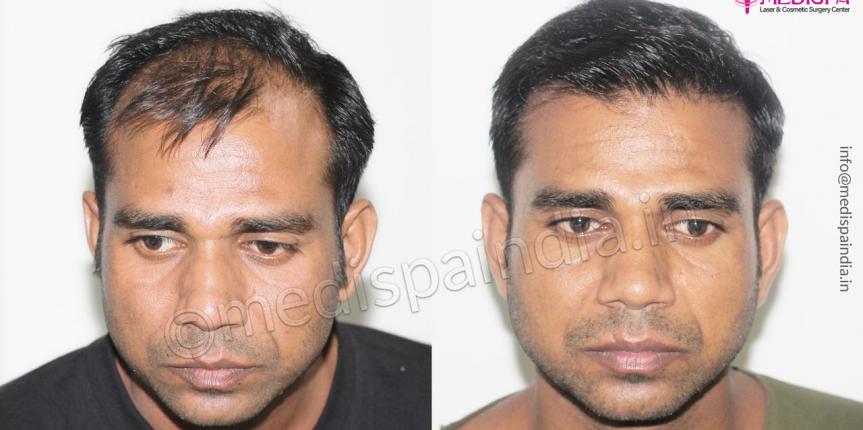 hair restoration before after india