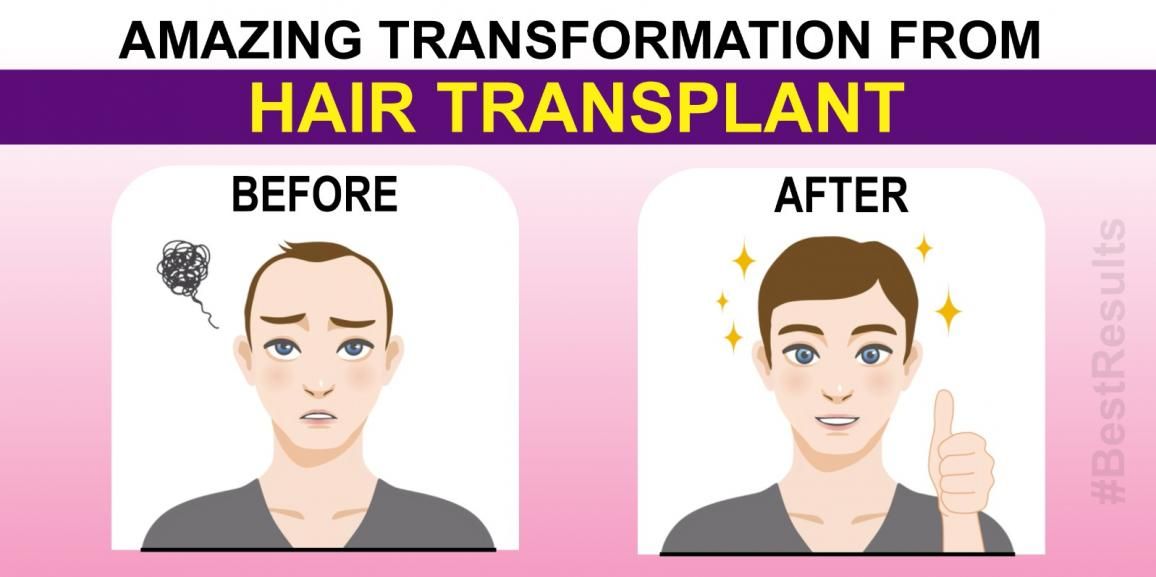 Understanding Hair Restoration: The Procedure, Cost And After Effects