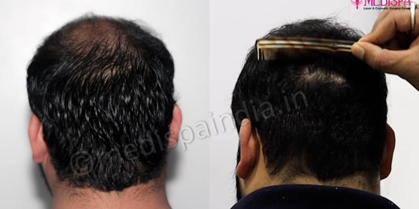 hair restoration india results