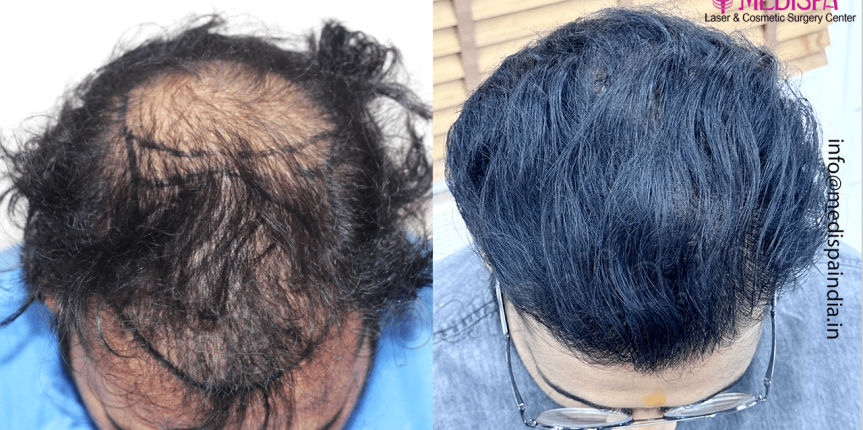india-hair-transplant