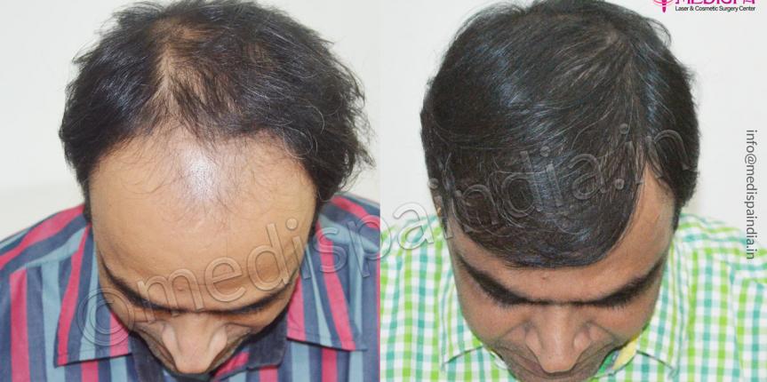 hair transplant jaipur near me