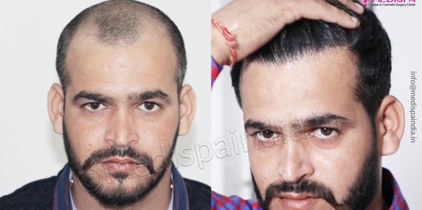 hair transplant after results jaipur rajasthan