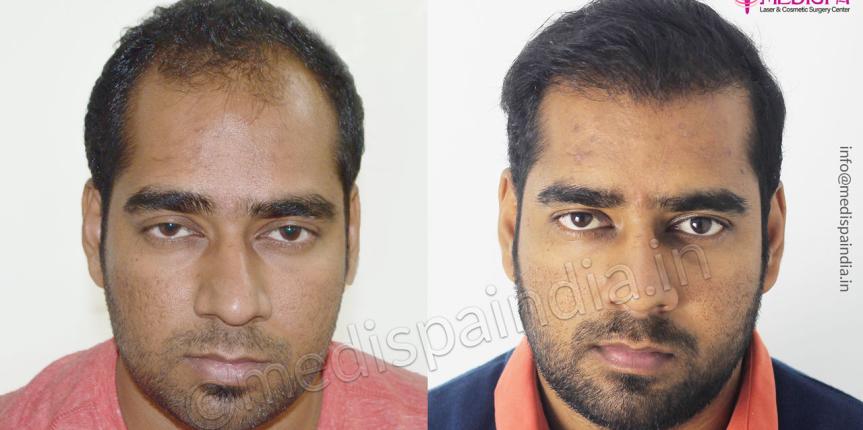 hair transplant in india cost