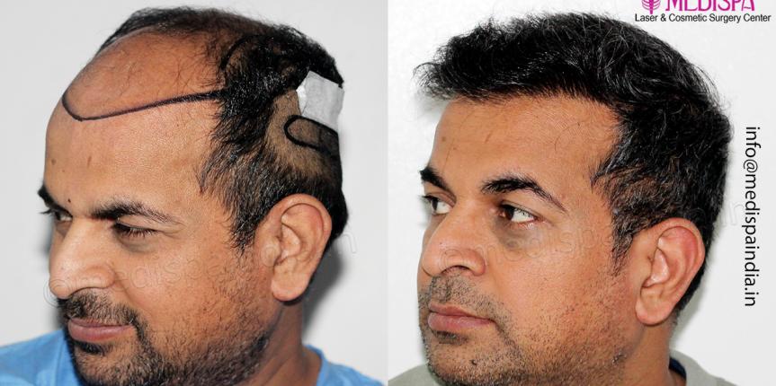 best hair transplant clinic results bangalore