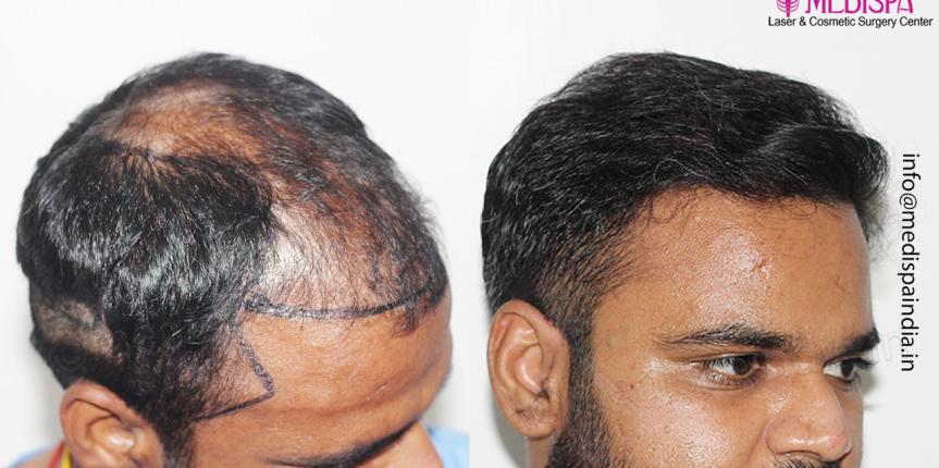 best hair restoration center results in hyderabad