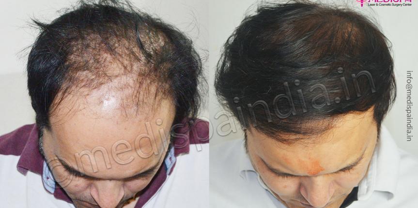 hair transplant in toronto