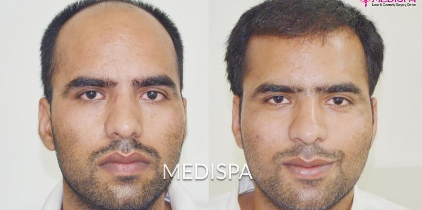 hair transplant cost in sydney