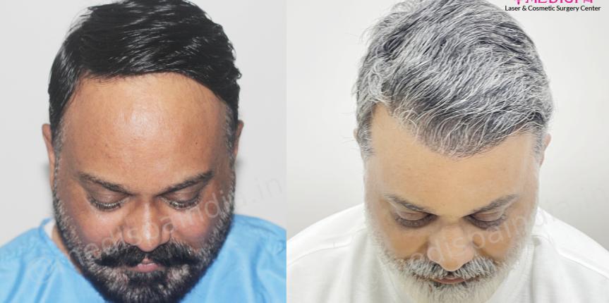Hair Transplant in India