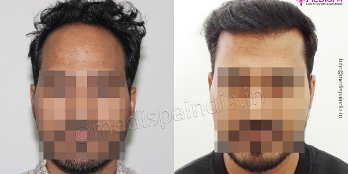 What Are The Factors To Be Considered Before Hair Transplant Surgery?