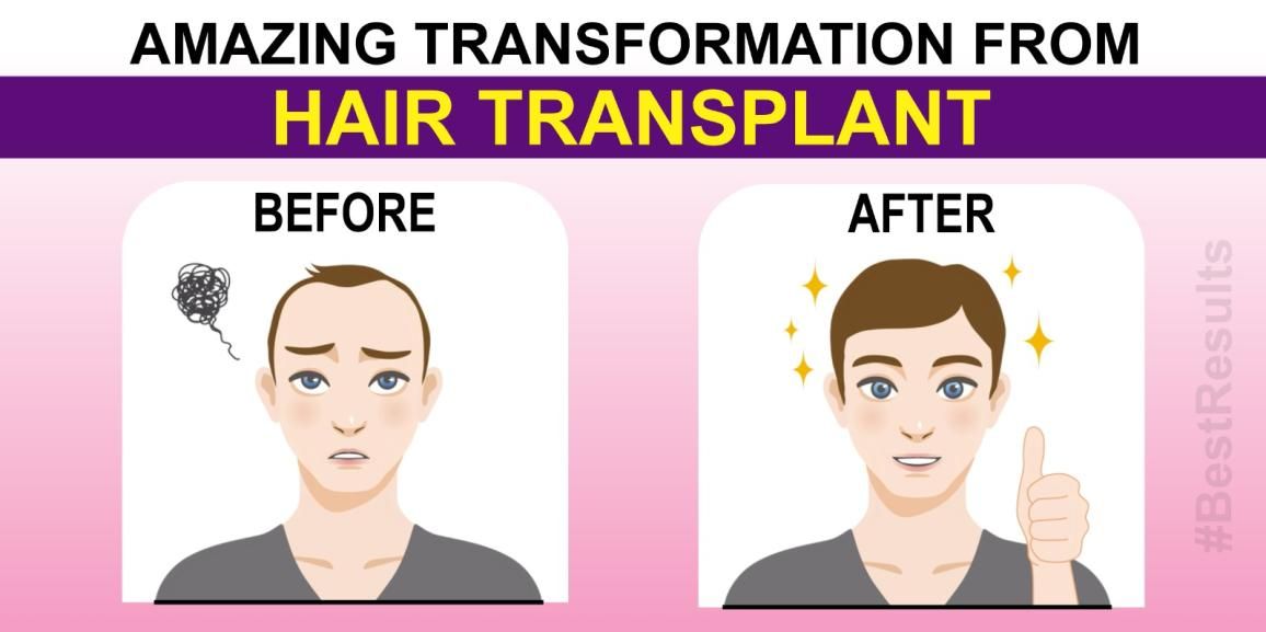 Hair Transplantation: Evaluating The Success of The Procedure