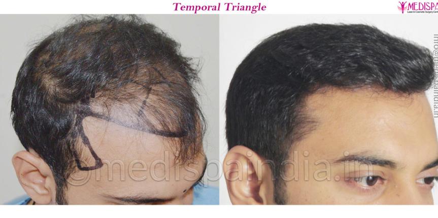 hair transplant clinic near me