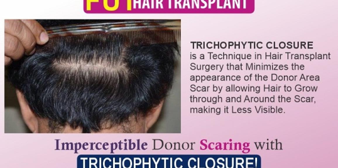 Explain The Significance of Trichophytic Closure in Hair Transplantation