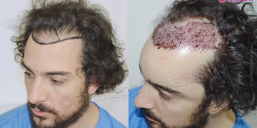 us hair restoration before after