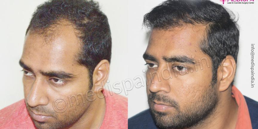 best hair transplant clinics in india