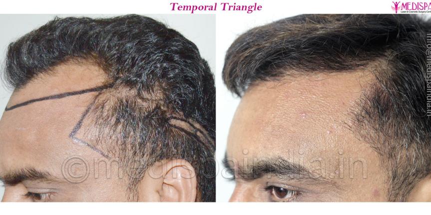 fue hair transplant australia