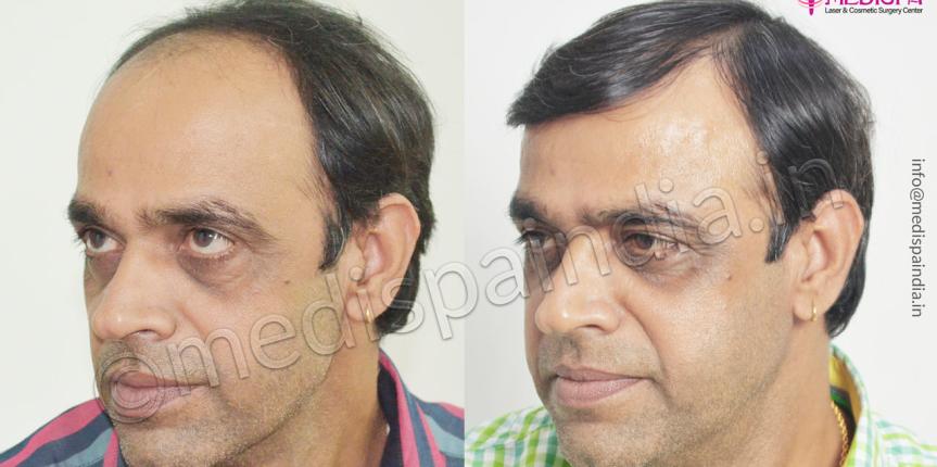 hair transplant in udaipur