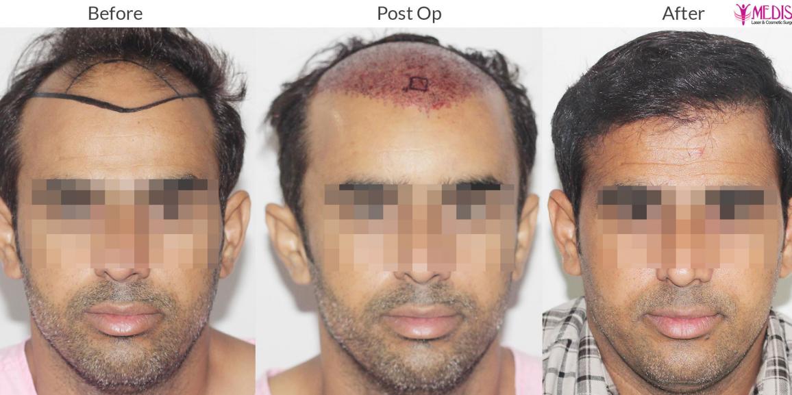 Why Hair Transplant is considered a safe procedure for Everyone?