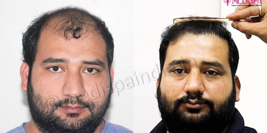 best hair transplant india results