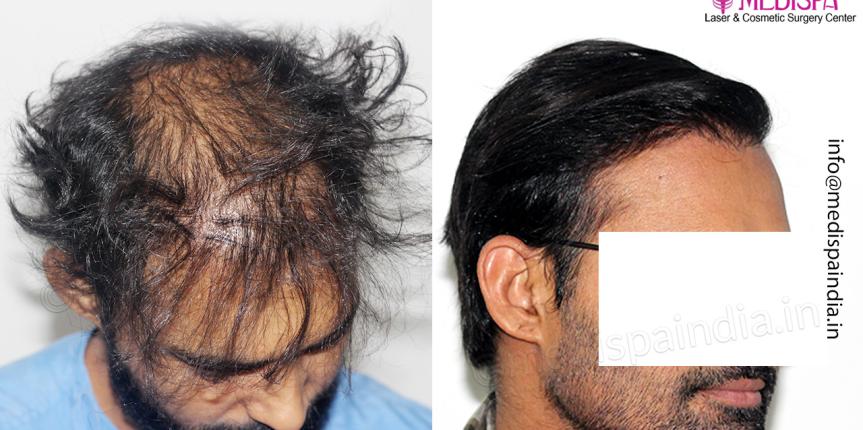 wrong hair transplant correction india