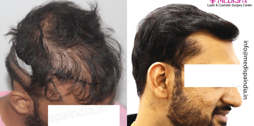 best-hair-restoration-jaipur