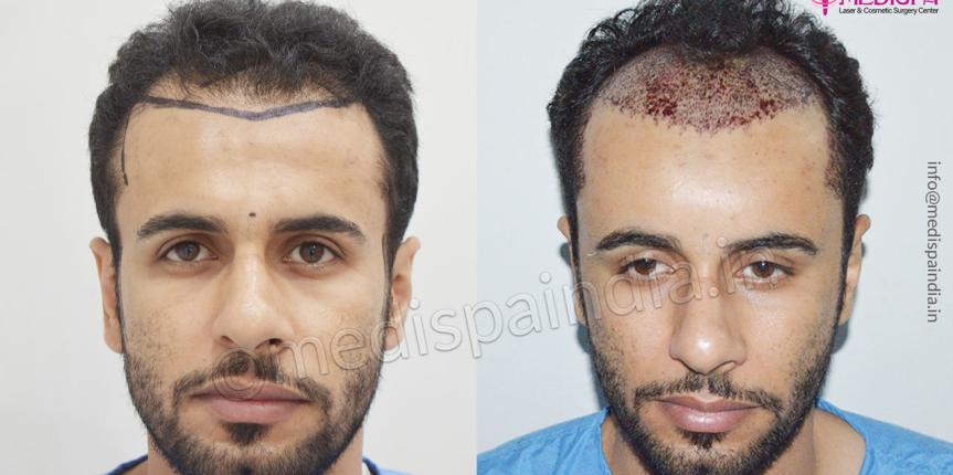 hair transplant dubai