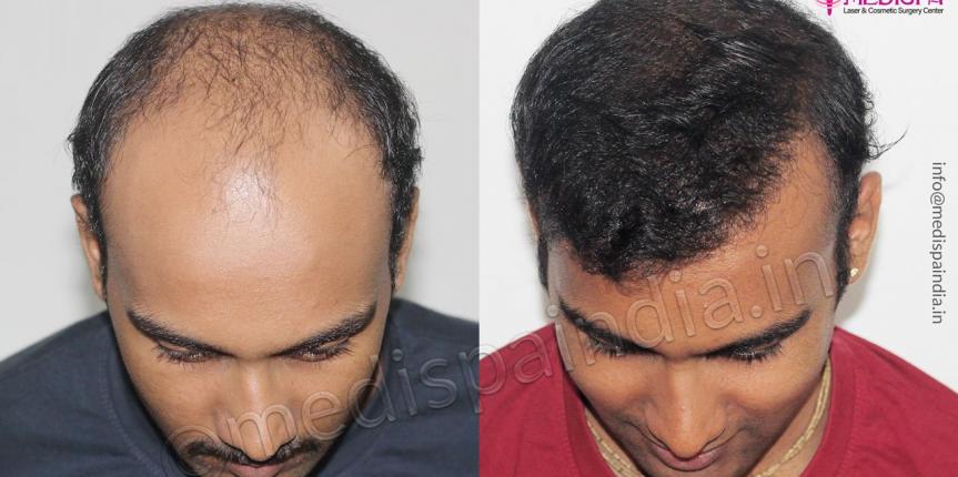 hair transplant cost in jaipur