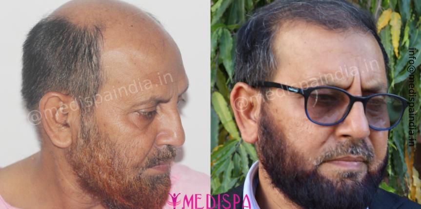 hair transplant india