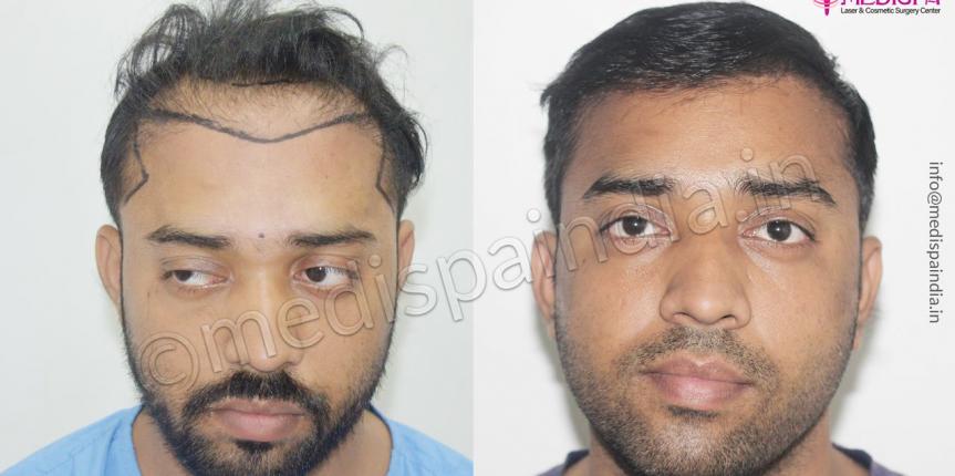 wrong hair transplant correction pune