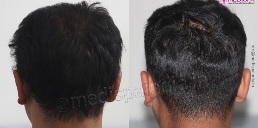 hair-transplant-results-rajatshan-jaipur