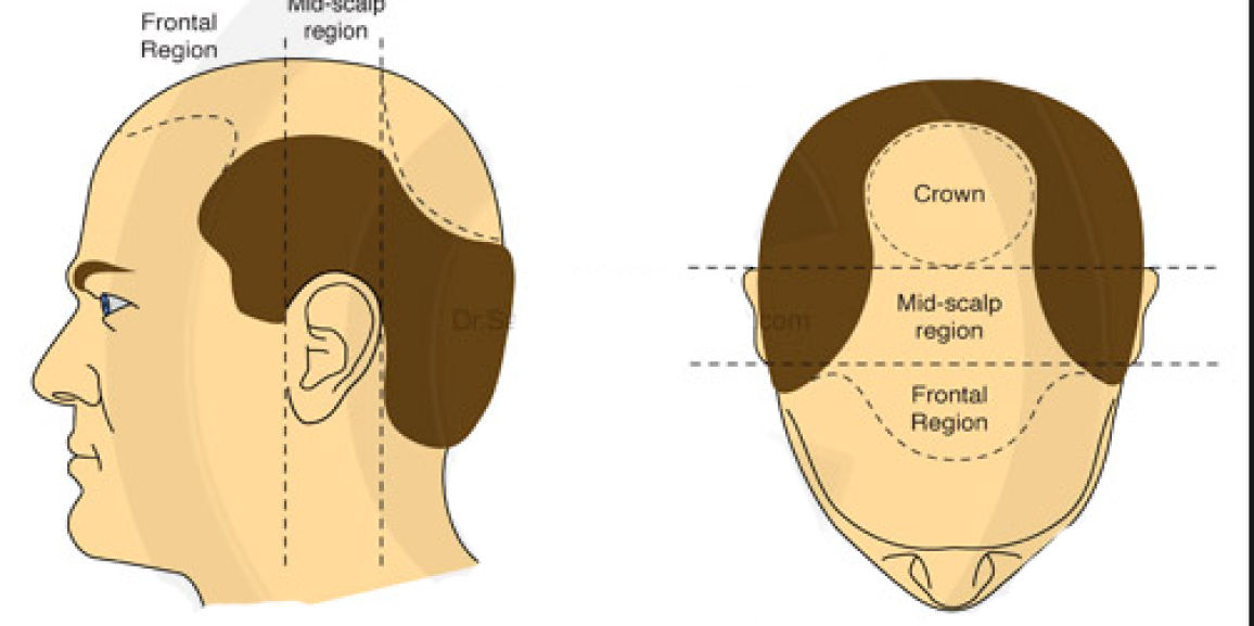 Top 10 Best Hair Transplant Clinics in Delhi NCR