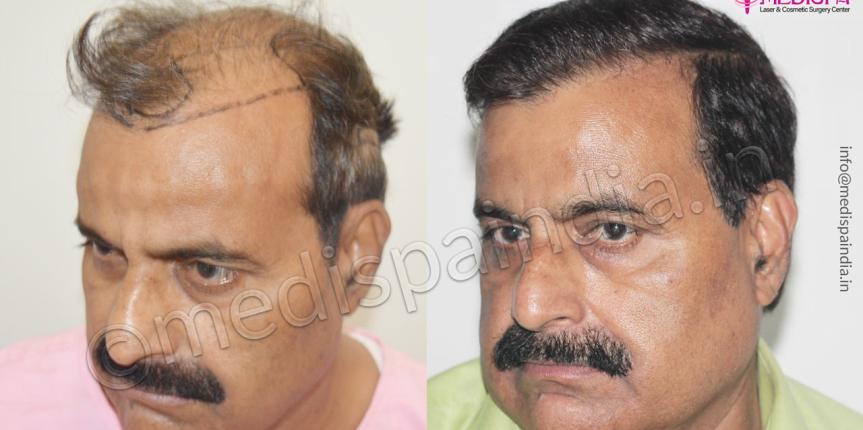 hair transplant surgeons in dubai