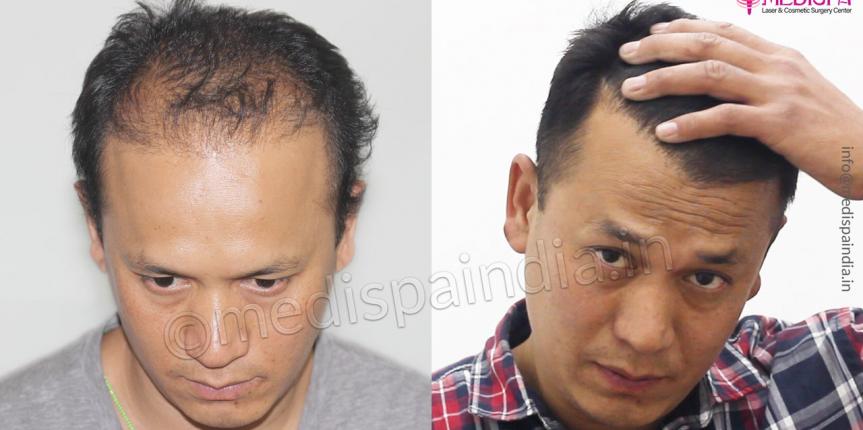 hair transplant results jaipur