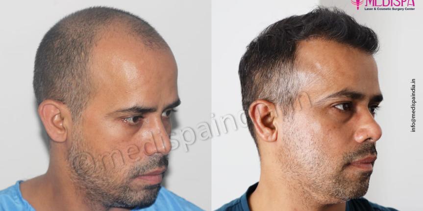 top hair restoration results india