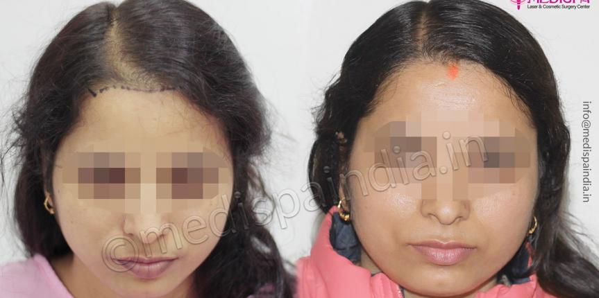 female hair transplant jaipur
