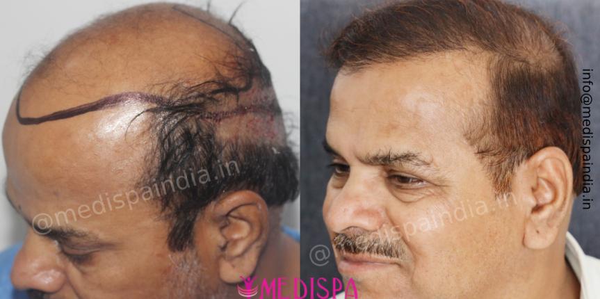 hair transplant delhi