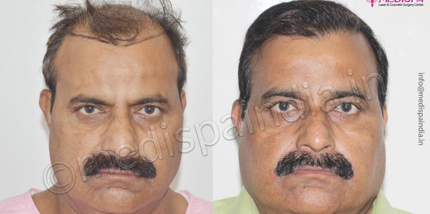 hair transplant clinics in dubai