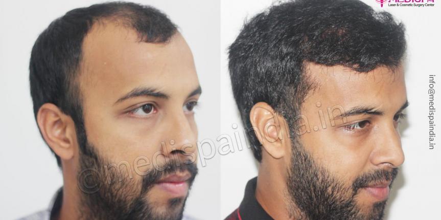 best hair transplant results delhi india