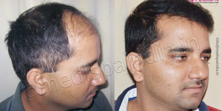 hair transplant in turkey