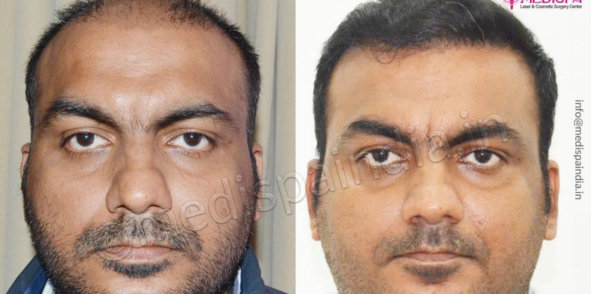 hair transplant in kota rajasthan