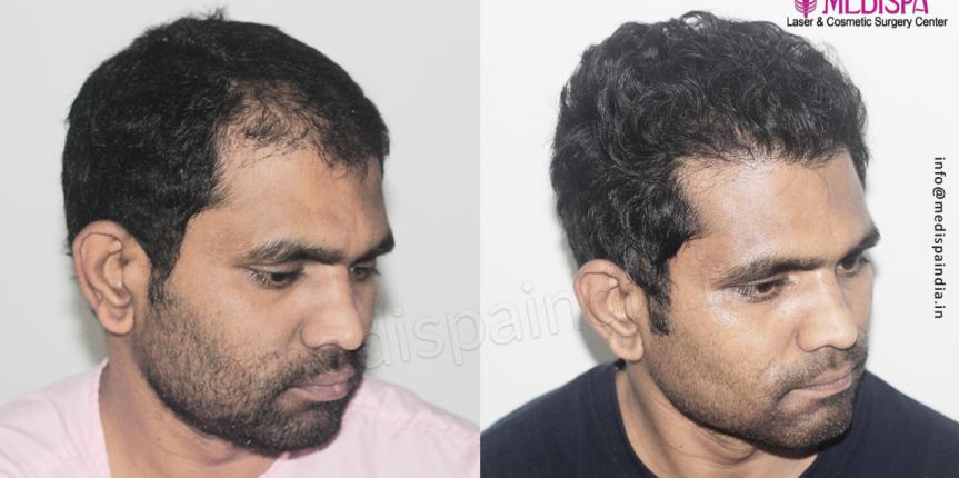 hair transplant before after in mumbai