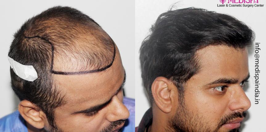 12 month hair transplant results